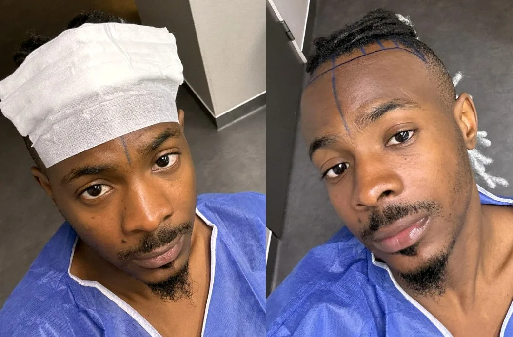 Young Jonn Undergoes Hair Transplant Surgery