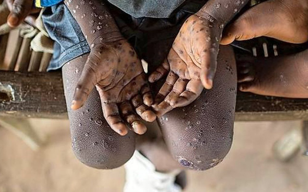 Mpox